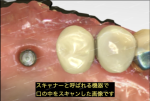 サイナスリフト　歯科インプラントの骨再生・造成のスキャンした画像です